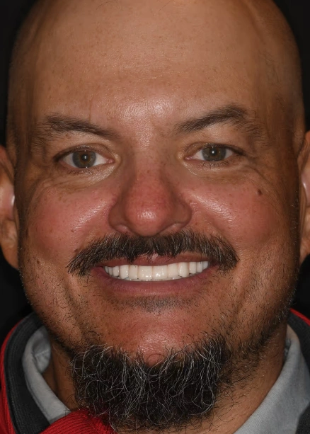 img-Real-Patients-Real-Results-five-after