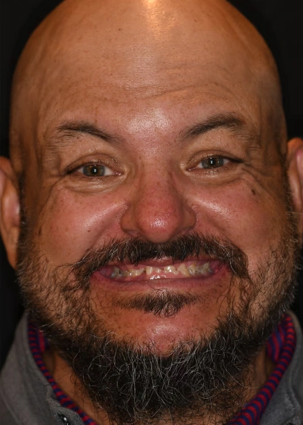 img-Real-Patients-Real-Results-five-before