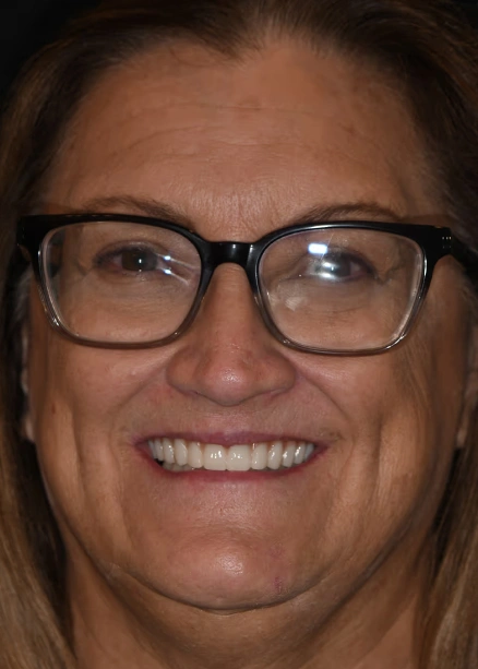 img-Real-Patients-Real-Results-four-after