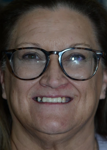 img-Real-Patients-Real-Results-four-before