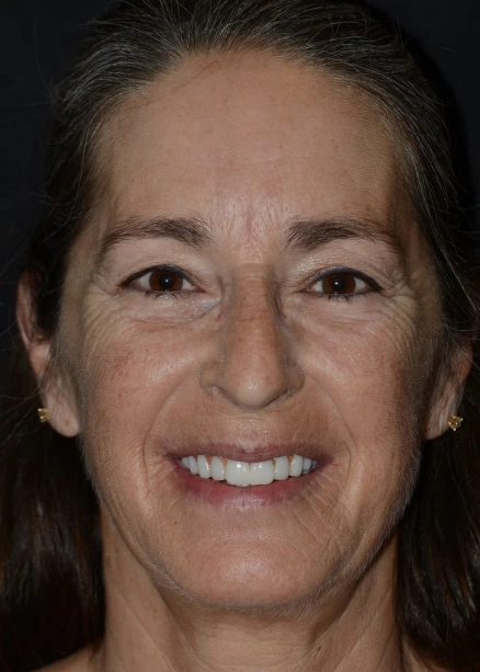 img-Real-Patients-Real-Results-one-after