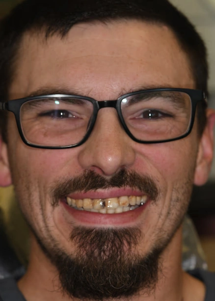 img-Real-Patients-Real-Results-six-before