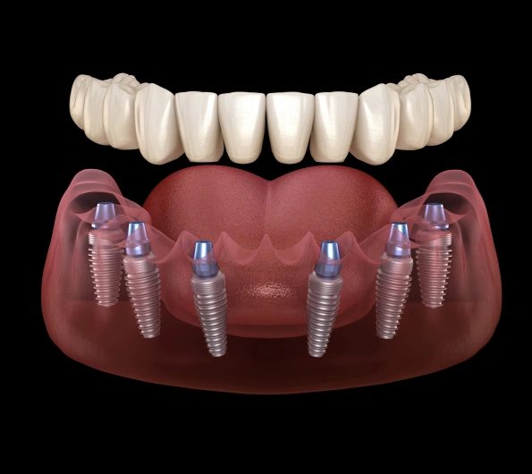Understanding Single-Tooth Implants