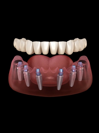 All-On-X Dental Implants