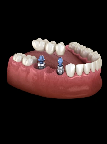 Implant-Supported Bridges