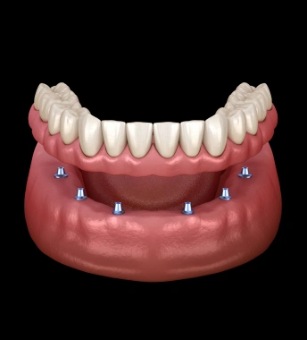 Implant-Supported Dentures