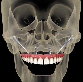 Remote Anchorage Dental Implants