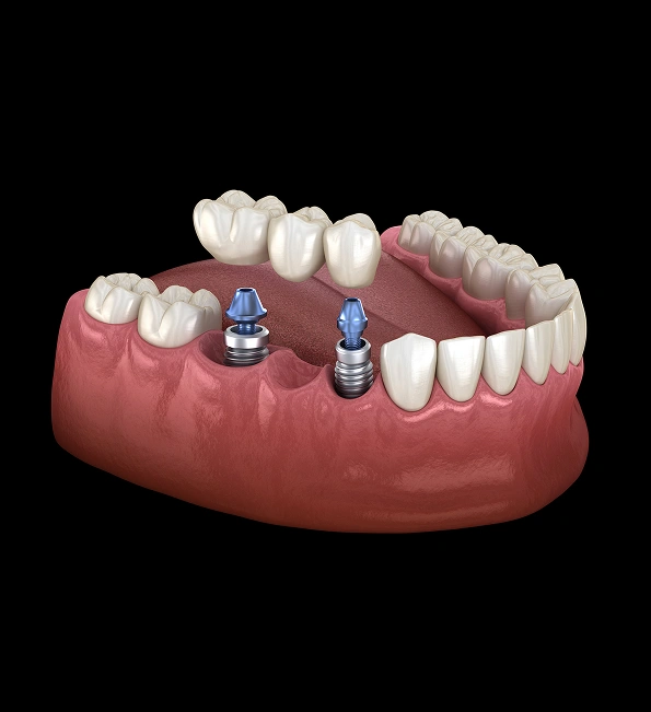 Imaplnts and Partials