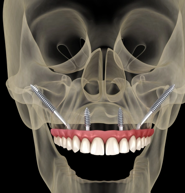 Imaplnts and Partials