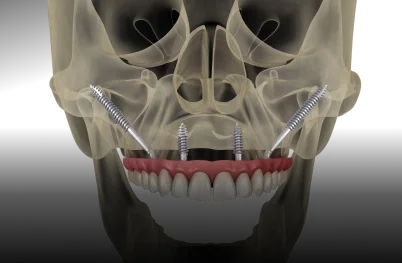Remote Anchorage Dental Implants
