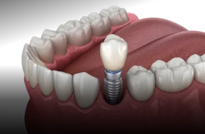 Single-Tooth Dental Implants