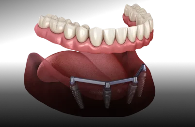 Immediate-Load “Same Day” Dental Implants