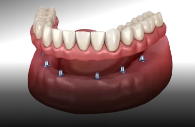 Implant-Supported Dentures